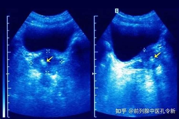 水溶肥钙是什么钙