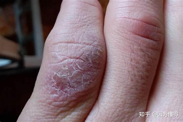 手碰到了肥料后就肿了是怎么回事