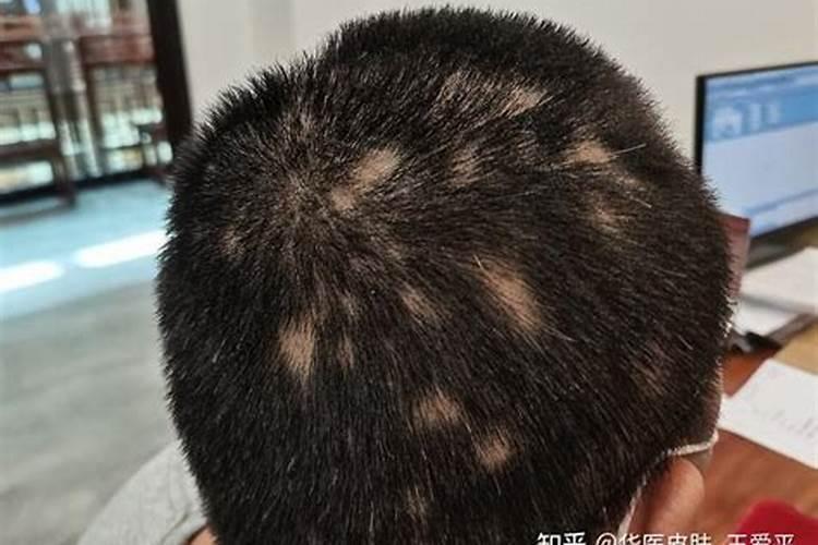 小孩斑秃是什么原因造成的