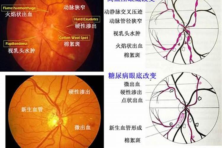 发财树上有粉蚧怎么办