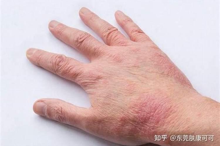 碳酸氢铵对人体的危害有哪些