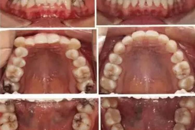 枣树小叶病最怕三个药